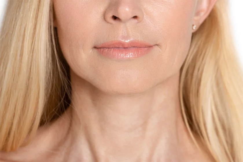 Mundwinkelfalten / Marionettenfalten unterspritzen Berlin